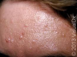 Image result for Sebaceous Hyperplasia