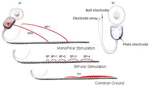 Cochlear Implant Stimulation Rates And Speech Perception