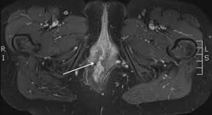 Ovarian cancer starts in the cells lining the ovaries. Digestive Diseases Mimicking Primary Gynecological Diseases Or With Secondary Gynecological Manifestations Sciencedirect