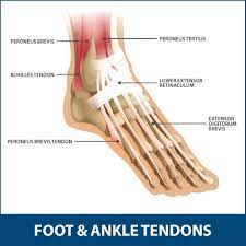 Achilles Tendinitis Info Florida Orthopaedic Institute
