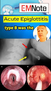 Image result for Epiglottitis
