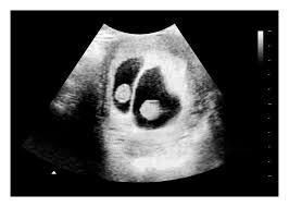 The fetal pole is the first visible sign of a developing embryo. 6 To 7 Weeks Twins Fake Ultrasound W Instant Download