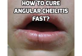 Angularcheilitiscauses Cracked Corners Of Mouth Mouth Sores Cracked Lips