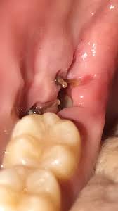 • if the tooth was removed with minimal trauma to the surrounding tissues (especially the bone), the hole is expected to seal close up withing the second or third day. This Hole Left From My Wisdom Tooth Where You Can See The Bone Popping