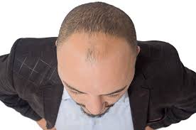 Why Do Some Men Go Bald While Others Don T Hair Transplant Going Bald Bald Heads Balding