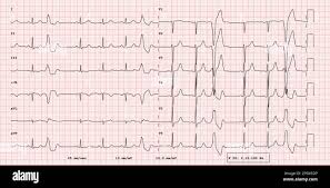 Image result for Extrasystole