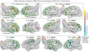 Image result for Thalamic Stimulation