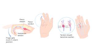 Image result for Trigger Finger