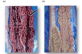 Image result for Intestinal Enteropathy