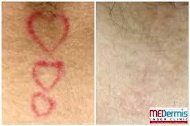However, the speed of the results depends on a number of variables: Neck Face Laser Tattoo Removal Before After Results Medermis