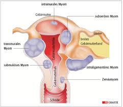 Das verfahren gehört noch nicht zur standardtherapie und wird erst in wenigen kliniken getestet. Uterusmyome Knoten In Der Gebarmutter Pta Forum