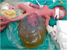 Silastic silo for gastroschisis & omphalocele. Giant Omphalocele Closure Utilizing Botulinum Toxin Sciencedirect
