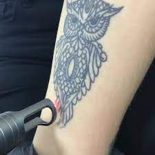 Lazerle Dovme Silme Islemi Q Switched Eryaman Guzellik Estetik
