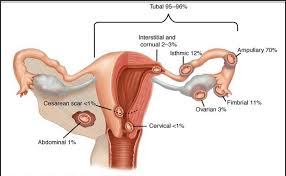 Tubal Pregnancy Symptoms