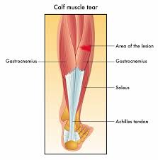 Patellar tendon tears are a relatively common and severe tendon injury. Gastrocnemius Tear Upswing Health