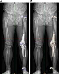 The attune® knee replacement has shown to fail in less than two years. Failed High Tibial Osteotomy A Joint Preserving Alternative To Total Knee Arthroplasty Sciencedirect