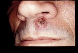 Disseminated Fungal Infection Infectious Disease Advisor Here's how to avoid them.