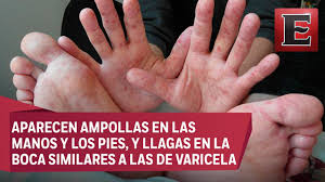 Transmision Sintomas Y Cuidados Del Virus De Coxsackie Youtube
