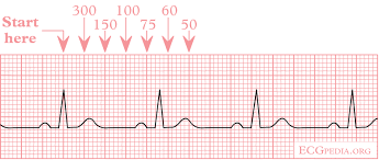 Heart Rate On Ekg Strip Calculation Of The Heart Rate