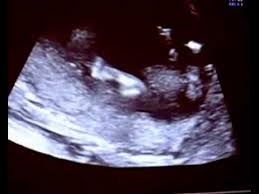 Dein baby kann in der 13. Ultraschall 13 Ssw Youtube