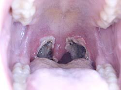Image result for Tonsillectomy