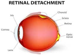 Our cherry hill office is located off of route 70 on ranoldo terrace with parking available on location. Retinal Detachment Health Tips Retinal Detachment Health Articles Health News Thehealthsite Com