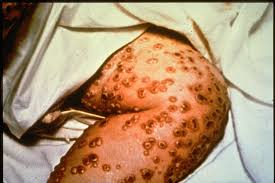 Image result for Smallpox