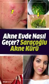 Akne Neden Olur Evde Nasil Gecer Ibrahim Saracoglu Akne Kuru Akne Nedenleri Akne Tedavisi Dogal Akne Tedavisi