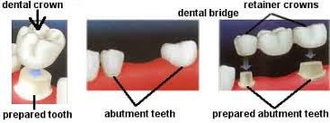 Dental Crown Procedure Dental Bridge Procedure