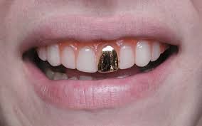 Pin By Vincent Robinson On Gold Teeth Gold Teeth Gold Tooth Cap Teeth Caps
