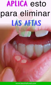 Remedios Caseros Para Las Aftas Aftas Bucales Remedios Remedios Para La Salud Aftas