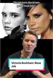 Analyzing Victoria Beckham's Rumored Nose Job
