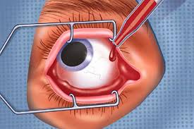 Intravitreale Injektionen Institut Fur Augenheilkunde