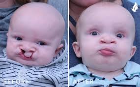 Image result for Cleft Lip