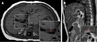 Biliary atresia is characterized by the destruction or absence of portions of the biliary system at a point (s) between the duodenum and the liver. Periportal Thickening On Magnetic Resonance Imaging For Hepatic Fibrosis In Infantile Cholestasis