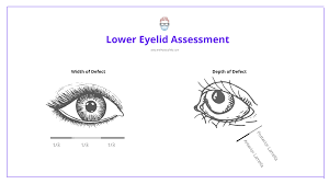 Image result for Eyelid Closure Defect