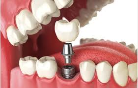 Types of Dental Implants in Korea - المركز الطبي لرعاية الأسنان