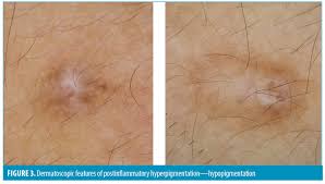 Image result for Postinflammatory Hypopigmentation