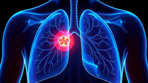 Image result for Emphysema