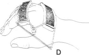 Short hand splints (SHS). (A) Short resting pan or paddle splint. (B)... |  Download Scientific Diagram