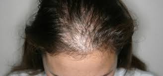For women, pattern hair loss occurs mostly when they are in their 50s and 60s. Female Pattern Baldness Causes And Treatments Dr Health Clinic