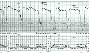 Image result for Variable Deceleration