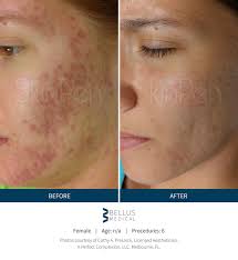 You can call them via phone number 9097986766. Microneedling Prp Natural Elegance Beauty