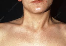 The good news about an acute case of wry neck is that it will likely improve over 48 hours from onset. Wry Neck Keyword Search Science Photo Library