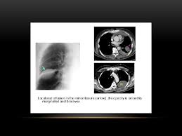 Maybe you would like to learn more about one of these? Pleural Disease Dr Nadya Ben Geweref Pleura Is
