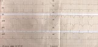 This noninvasive test shows your heart's electrical patterns and can detect if myocarditis is causing heart failure or arrhythmias, your doctor might hospitalize you and. Myocarditis Presenting As Typical Acute Myocardial Infarction A Case Report And Review Of The Literature