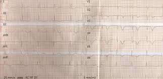 The disease is commonly caused by viral. Myocarditis Presenting As Typical Acute Myocardial Infarction A Case Report And Review Of The Literature