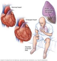 A less common cause is a severe spasm, or sudden contraction, of a coronary artery that can stop blood flow to the heart muscle. Heart Failure Symptoms And Causes Mayo Clinic