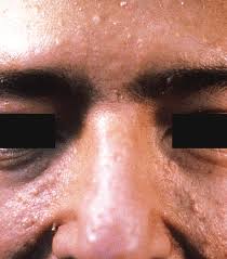Muir Torre Syndrome