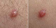 A prospective study in spain // bmc infect. Humane Papillomviren Wikipedia